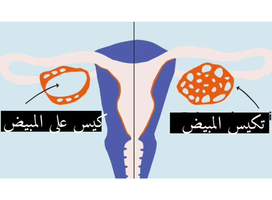 سرطان المبيض